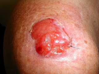 Before surgery