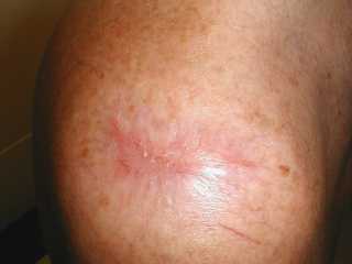 After surgery