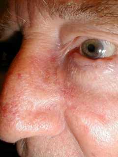 13 days after surgery